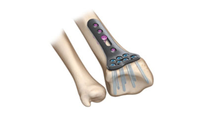 VariAx 2 distal radius